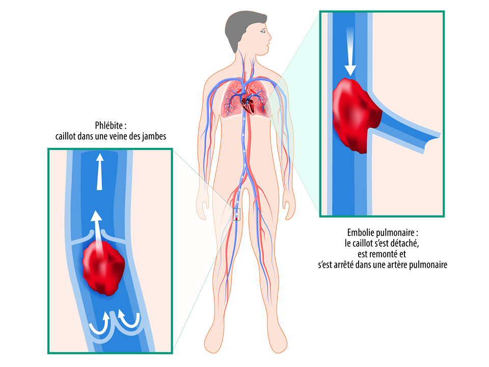 Phlébite et embolie pulmonaire