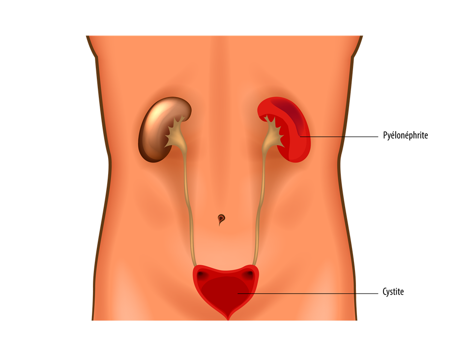Infection urinaire : cystite, pyélonéphrite